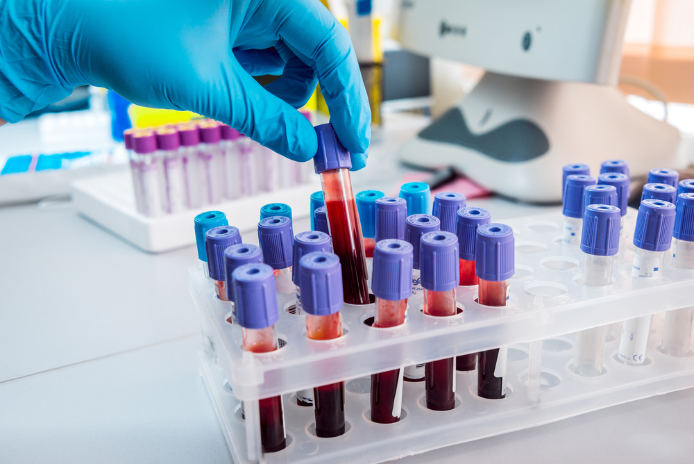MB検査｜血液でがんの”リスク”を調べる最先端の検査方法